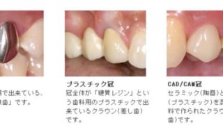 笑ったときにチラッと見える銀歯が気になりませんか？ | 痛みの少ない